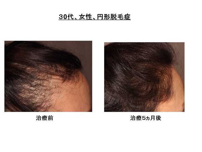 円形脱毛症　病院""